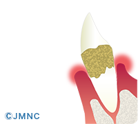 歯周病とは