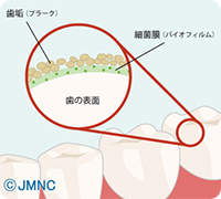 プラークコントロール